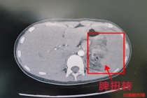 女童腹痛呕吐竟是罕见脾扭转 紧急手术挽救生命