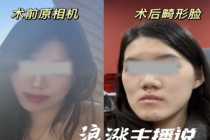 女孩做正颌手术反成鞋拔子脸 卫健委介入调查