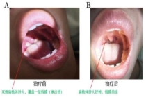 男子高热咽痛 患上“亲吻病” 警惕传单疾病