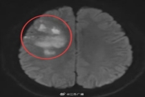 29岁230斤小伙一觉醒来突发脑梗 肥胖与不良习惯埋下隐患