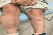 男孩身上突然爬满青斑血肿 生吃蔬菜惹的祸