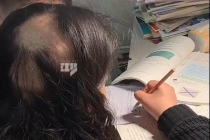 85后宝妈遭遇鬼剃头 辅导作业压力大