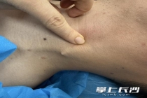 男子硬吞饭团把鱼刺扎进颈部皮下 医生精准微创10分钟取出