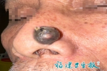 大爷鼻子上长了小疙瘩竟确诊是癌 不疼不痒却暗藏危机