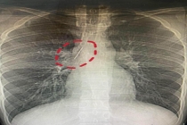 男子体检发现胸腔藏了一根缝衣针 十余年“与针共存”奇迹