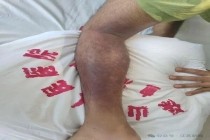 男子踩蛇窝被咬休克 多蛇连咬生死救援