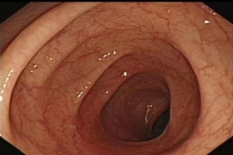 女子便秘10年被切30厘米肠管 长期滥用通便茶的代价