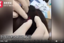 女子清理猫砂遭爱猫突袭 脸、颈多处抓伤并有颅部3级损伤