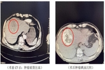 七旬奶奶跳广场舞太激烈致肿瘤破裂 微创手术化险为夷