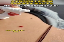 女子随手把身上疙瘩抠破血流不止 小动作引发大问题